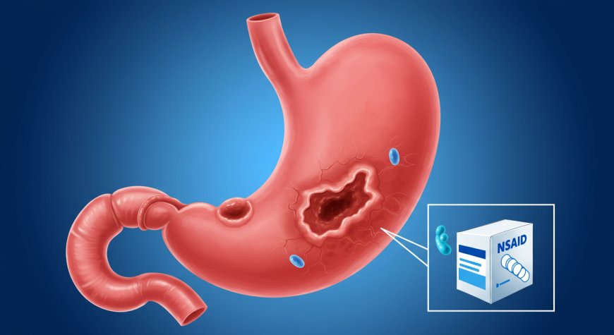 Mide Ülseri: Belirtileri, Tanısı ve Tedavisi